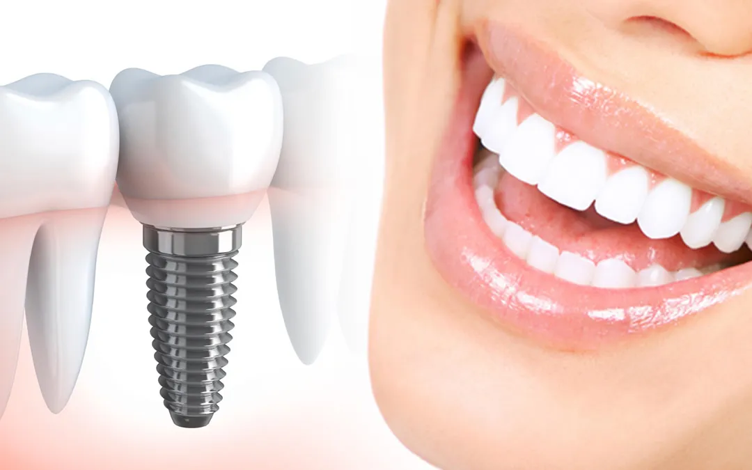 Problems and Complications With Dental Implants